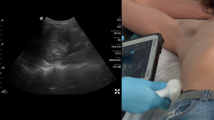 Lung Ultrasound Video 1