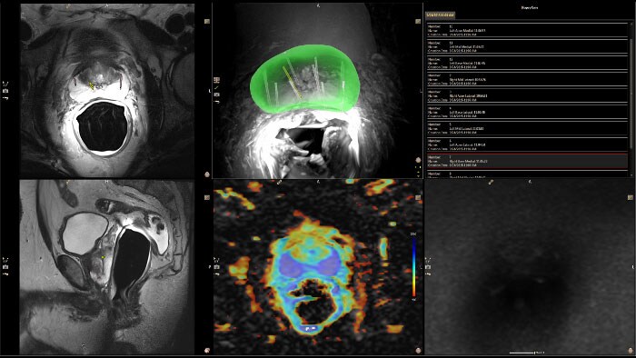 invivo dynacad prostate