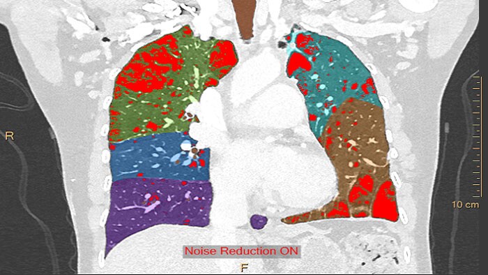 CT COPD