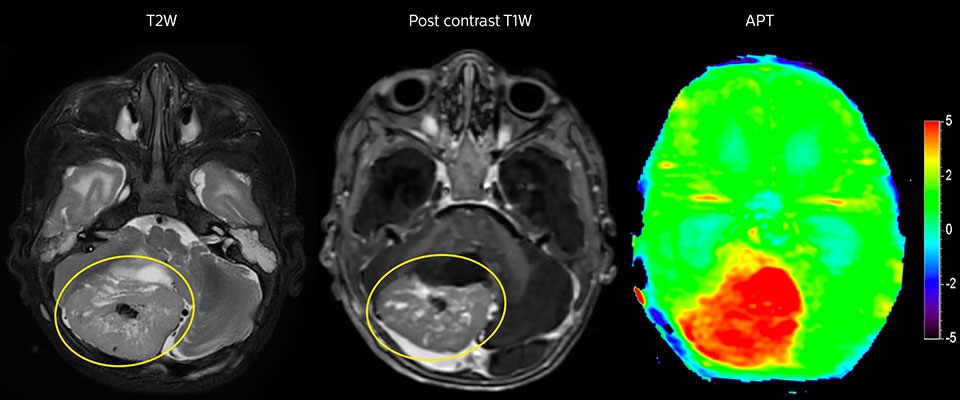 APT-Bildgebung eines hoch differenzierten Tumors