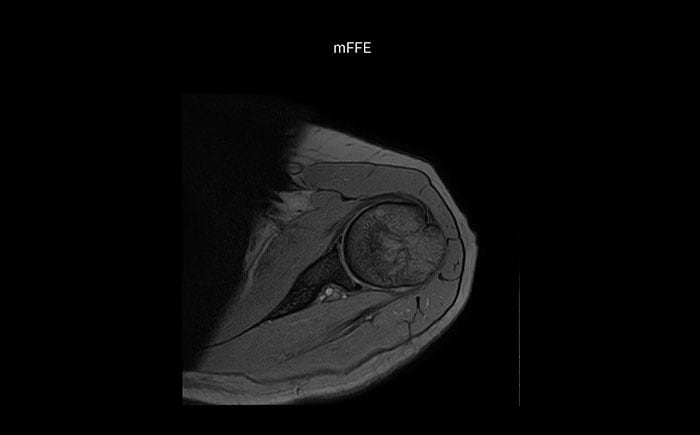 MRT Schulter mit hoher Qualität, mFFE