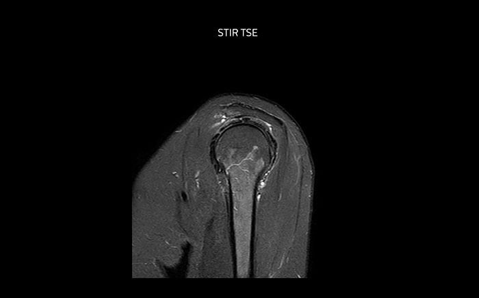 MRT Schulter mit hoher Qualität, STIR TSE