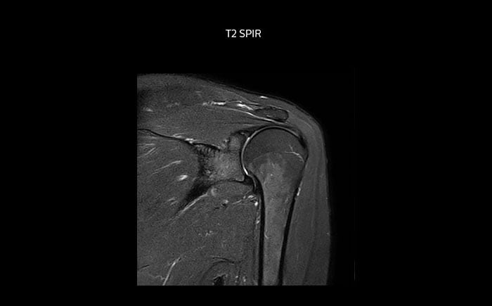 MRT Schulter mit hoher Qualität, T2 SPIR