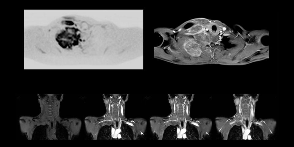 MRT Pancoast-Tumor