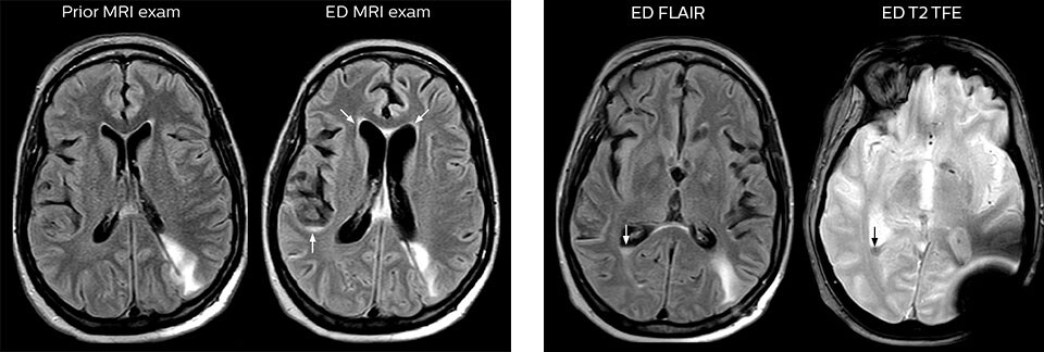 MRT zur Erkennung von Anzeichen für Meningeosis neoplastica