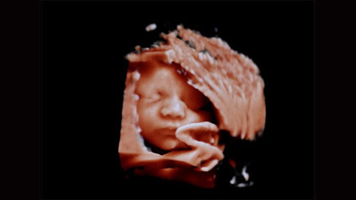 Ultraschallbild des Gesichts eines Fetus mit Philips Affiniti ohne Anwendung von aReveal