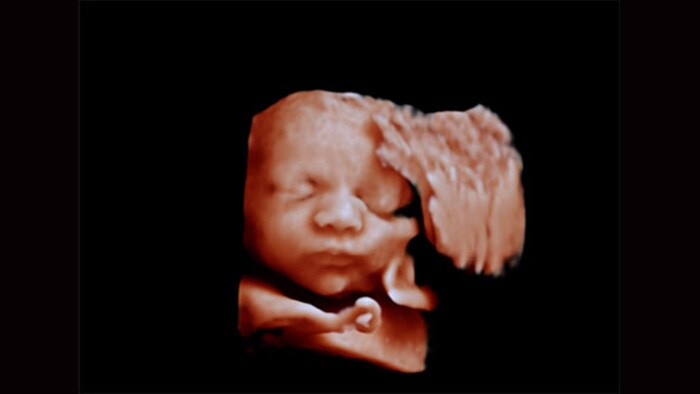 Ultraschallbild des Gesichts eines Fetus mit Philips Affiniti mit Anwendung von aReveal