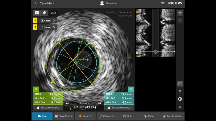 Intravaskulärer Ultraschall (IVUS)