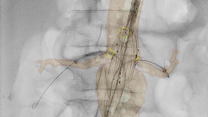 2D Perfusion Gefäßchirurgie Miniaturbild