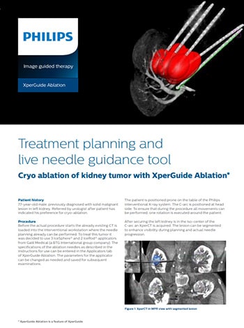 Clinical case report XperGuide Ablation