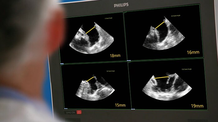 EPIQ CVxi interventionelles Ultraschallsystem