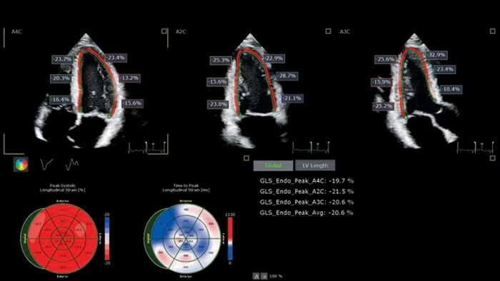 Video X5-1c AutoStrain