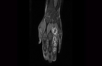 Tumor in Hand/Handgelenk