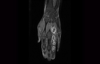 Tumor in Hand/Handgelenk