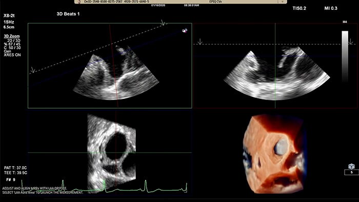 Die Philips Lösung zur Diagnose des linken Vorhofohrs auf dem EPIQ CVx