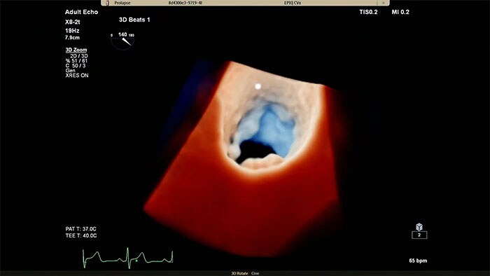 Philips Cardiac TrueVue auf dem EPIQ CVx.