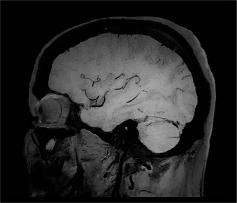 Black-Blood-Bildgebung für höhere Diagnosesicherheit bei der Bildgebung des Gehirns​