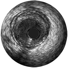 Rotations-IVUS-Bildverarbeitung