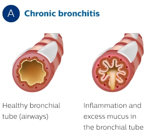 Querschnitt der Bronchien