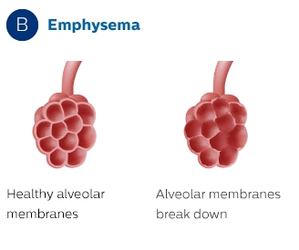 Alveolarmembranen