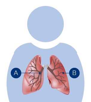 Appareil D'exercice De Soulagement Du Mucus, Appareil D'exercice Des  Poumons De Santé Respiratoire Gratuit Pour L'extérieur Bleu