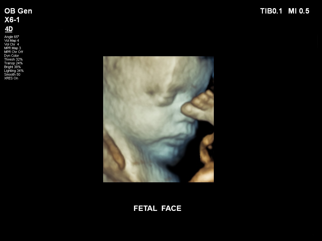 Ultraschallbild Gynäkologie Beispiel 11