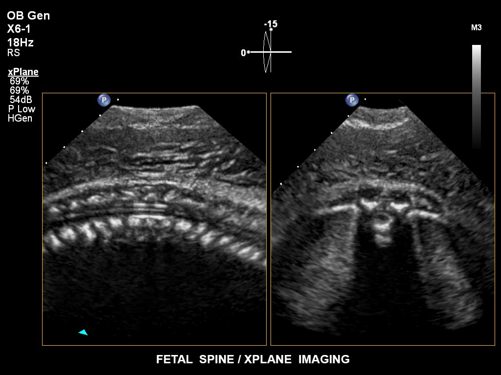 Ultraschallbild Gynäkologie Beispiel 16