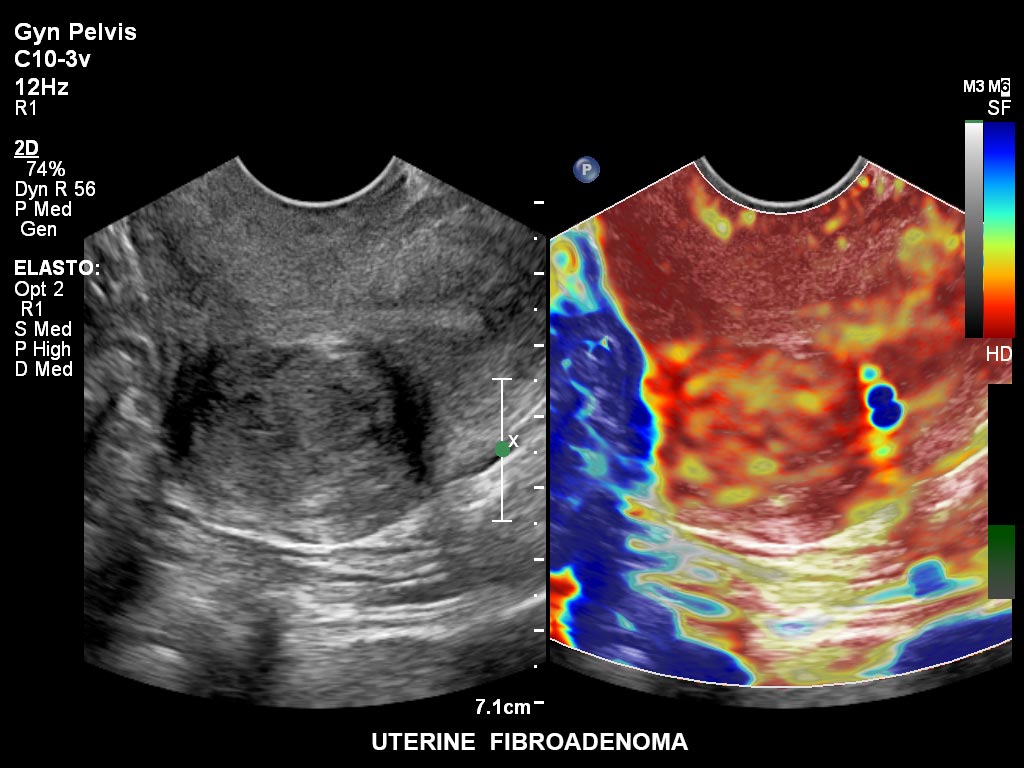 Ultraschallbild Gynäkologie Beispiel 19