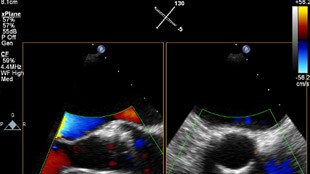 You can interrogate Live 3D data to help plan TAVR 